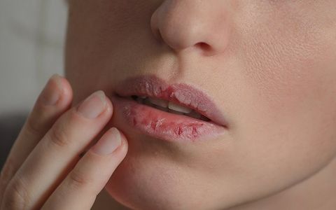 Woman with Dry Lips — Clarkston, MI — Mark Frenchi DDS