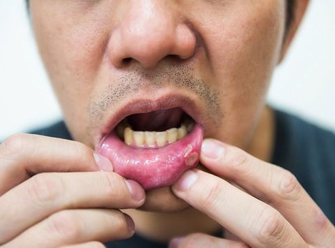Man with Canker Sore — Clarkston, MI — Mark Frenchi DDS