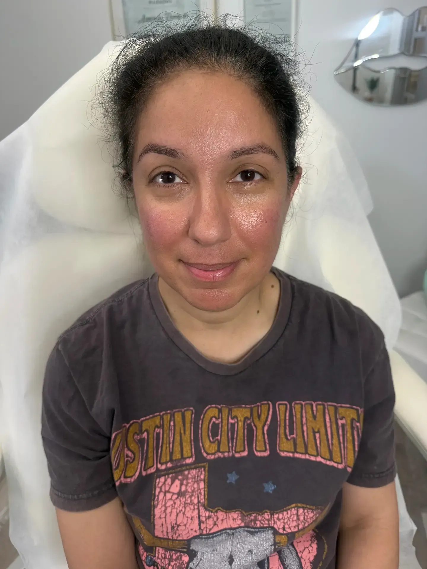 Woman with reddish skin sits in a chair, likely after a cosmetic treatment. She wears a dark t-shirt and looks at the camera.
