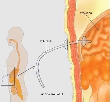 Gastrostomy — PEG Procedure Chart in Louisville, KY