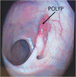 Cancer Screening —Hemorrhoid And Polyp In White Background in Louisville, KY