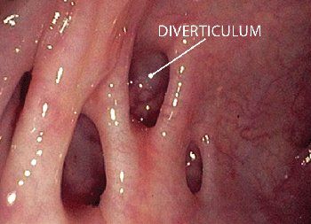 Gastrostomy — Zoom In Of Diverticulosis in Louisville, KY