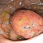 Gastrostomy — Rectal Polyps in Louisville, KY