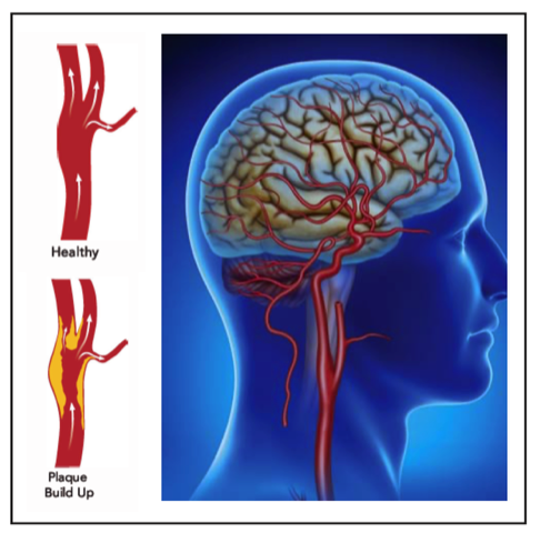 Carotid Artery Disease | Arkansas Vascular & Vein Specialists | Little ...