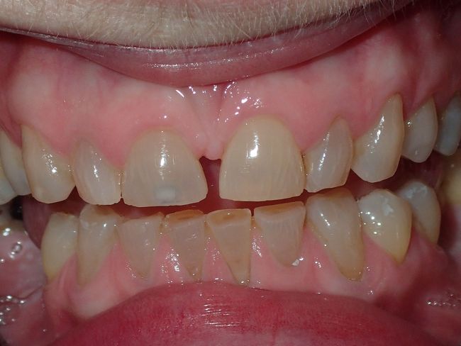 A close up of a person 's teeth with a missing tooth.