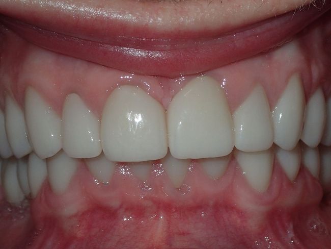 A close up of a person 's teeth with white teeth.