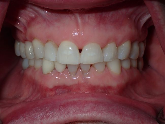 A close up of a person 's teeth with a hole in the middle.