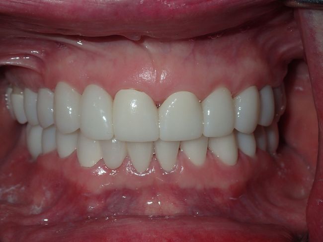 A close up of a person 's teeth with white teeth.