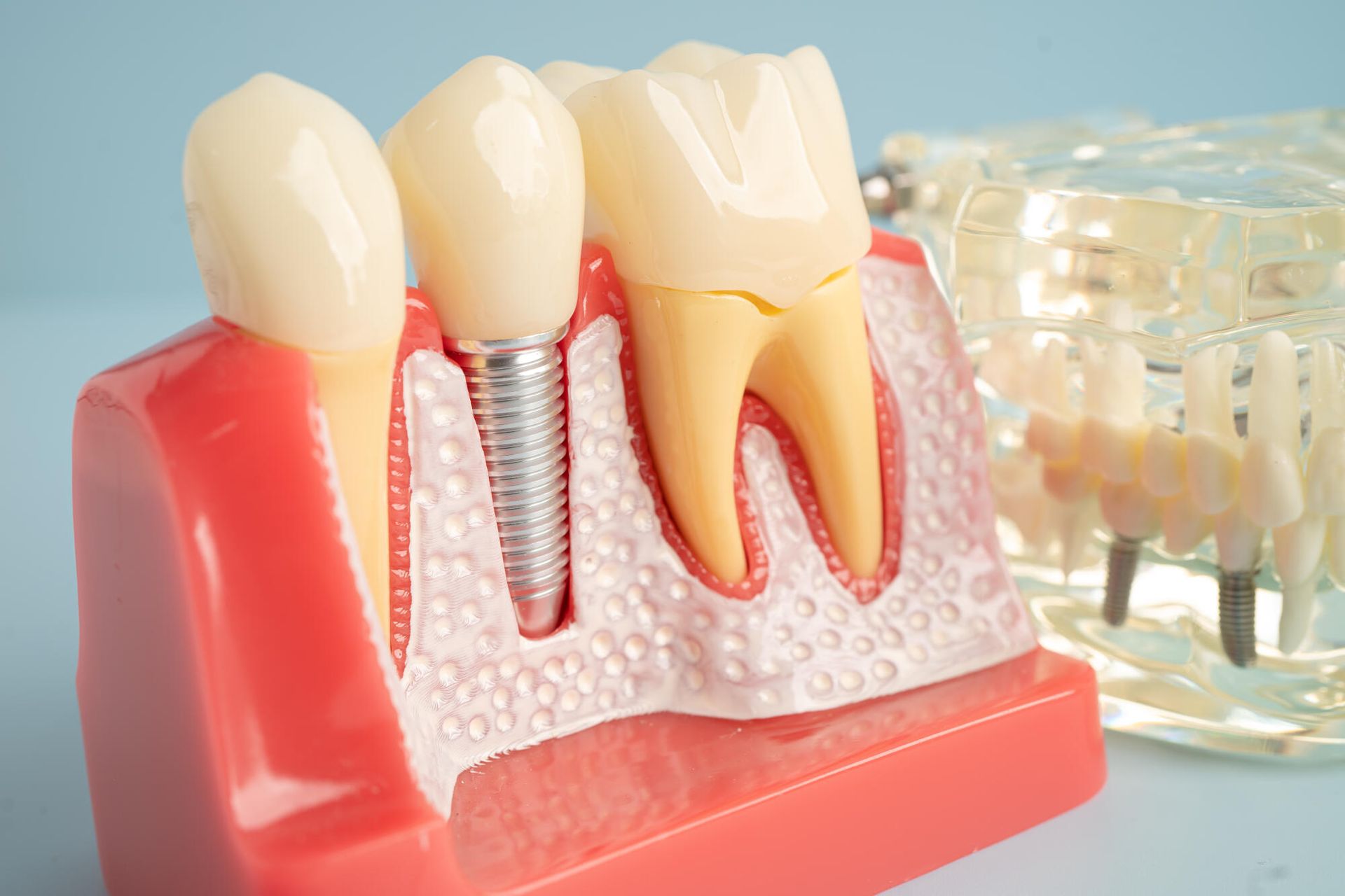 A model of a tooth with a dental implant in it.