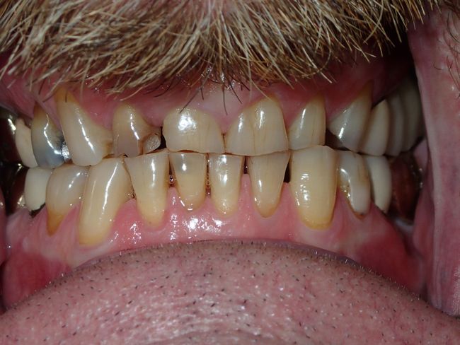 A close up of a man 's teeth with a beard.