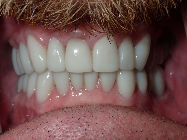 A close up of a man 's teeth with a beard.