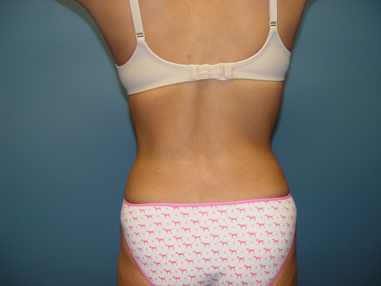 abdominoplasty tummy tuck surgery in Charleston