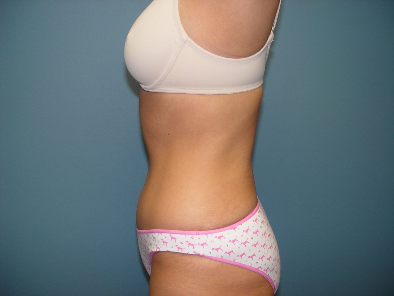 abdominoplasty tummy tuck surgery in Charleston