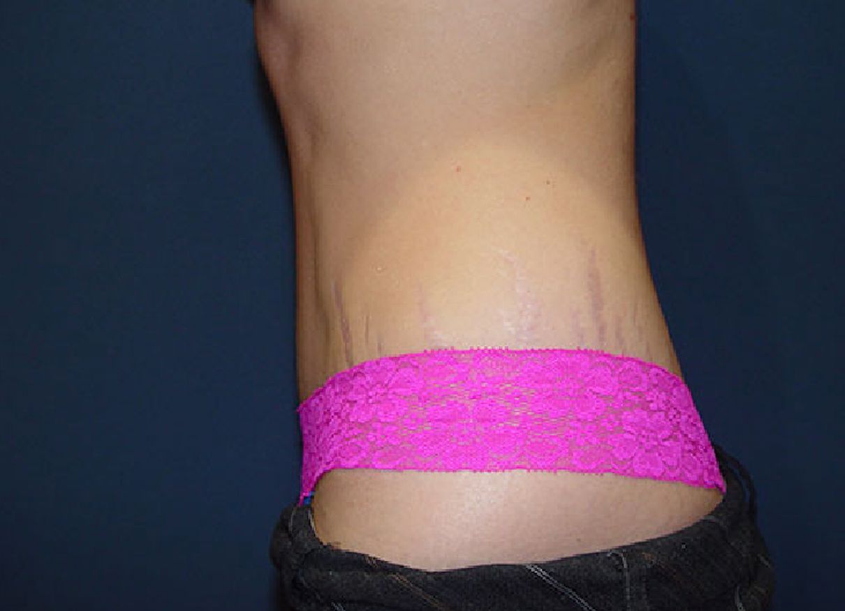 abdominoplasty tummy tuck surgery in Charleston