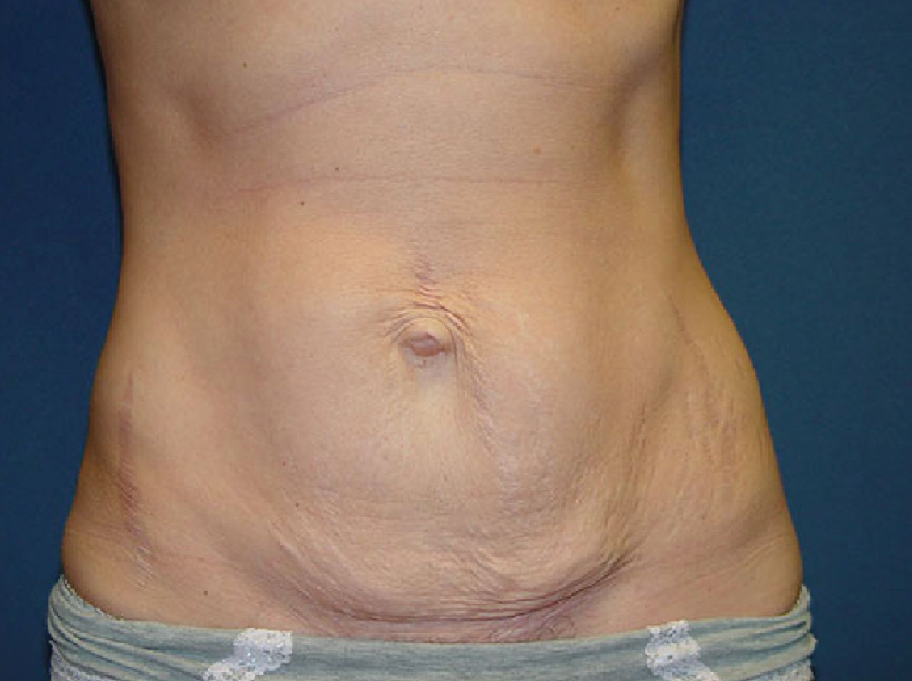A close up of a woman 's stomach with a large belly button.
