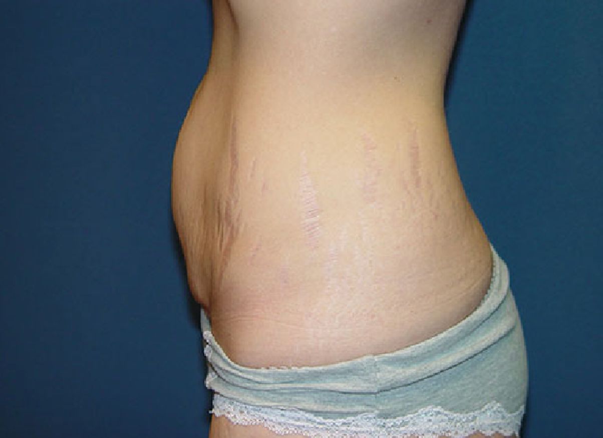A woman 's stomach with a lot of stretch marks on it.