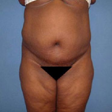 abdominoplasty tummy tuck surgery in Charleston