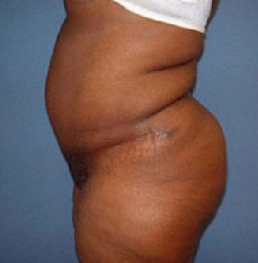 abdominoplasty tummy tuck surgery in Charleston