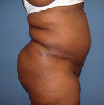 abdominoplasty tummy tuck surgery in Charleston