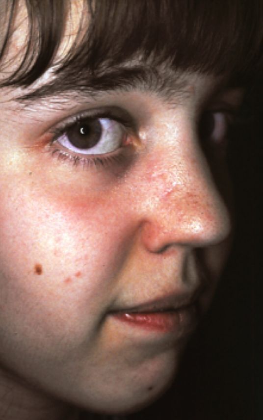 birthmark removal surgery