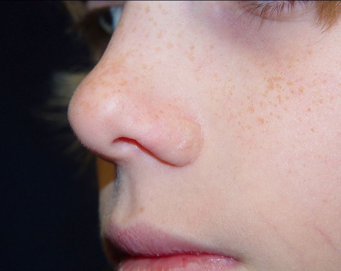 birthmark removal surgery