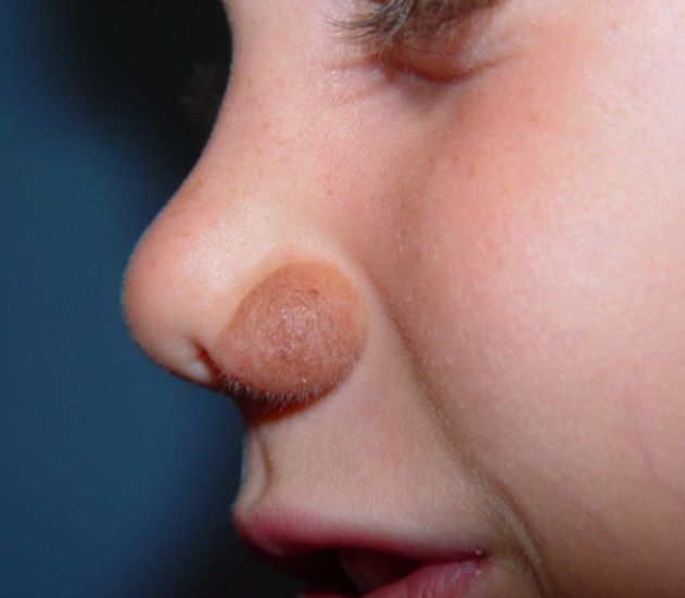 A close up of a child 's nose with a brown spot on it.