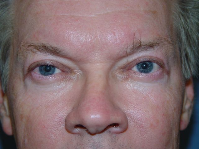 A close up of a man 's face with blue eyes and a red nose.