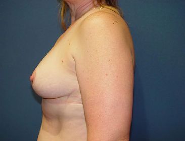 boob job post surgery