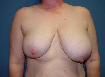 breast reduction surgery pre op