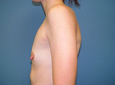 breast augmentation pre op