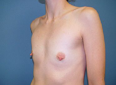 boob job pre op