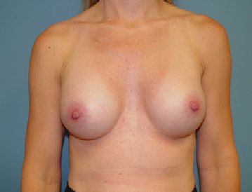 breast reconstruction post op