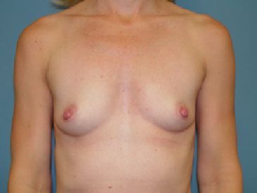 breast reconstruction pre op