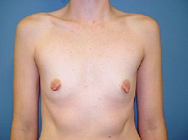 breast reconstruction pre op