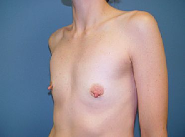 breast reconstruction pre op