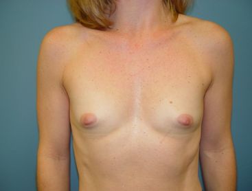 breast reconstruction pre op