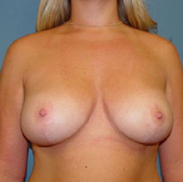 breast lift