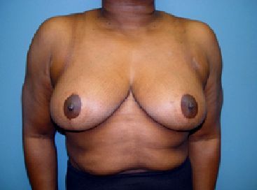 breast reduction surgery charleston