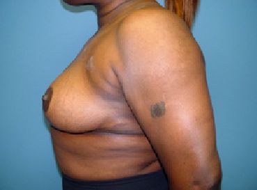 breast reduction surgery charleston