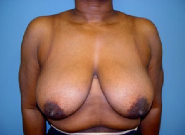 breast reduction pre op