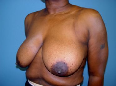 breast reduction pre op