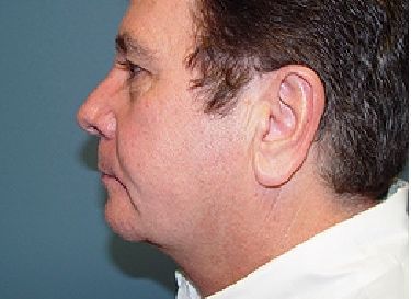 neck lift post op charleston