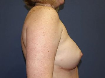 breast reconstruction post op