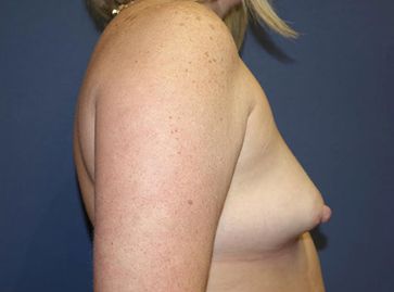 breast reconstruction pre op