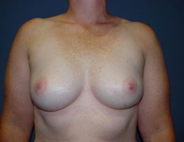 breast reconstruction