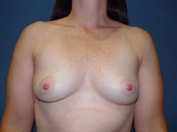 breast reconstruction