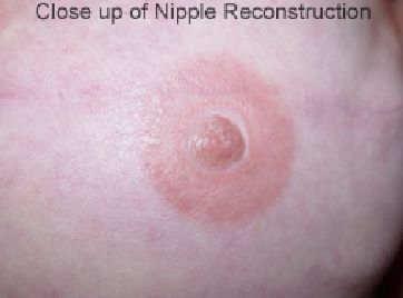 nipple post op boob job