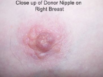 nipple pre op boob job