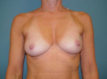 breast reconstruction
