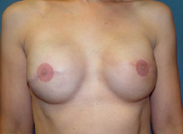 breast reconstruction post op